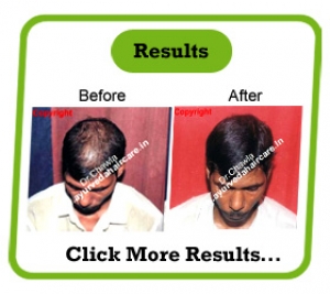 Alopecia universalis - Ayurveda Hair Care